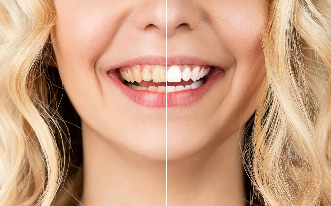 Wybielanie zębów innowacyjną metodą Prevdent
